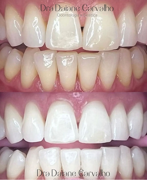 Resultado de clareamento dental, caso 2, realizado no consultório da Dra. Daiane Carvalho na Barra Funda, São Paulo