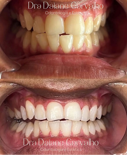 Resultado de clareamento dental, caso 3, realizado no consultório da Dra. Daiane Carvalho na Barra Funda, São Paulo